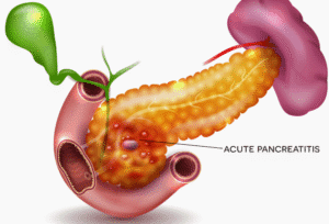 ayurveda and pancreatitis