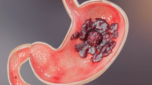 peptic ulcer