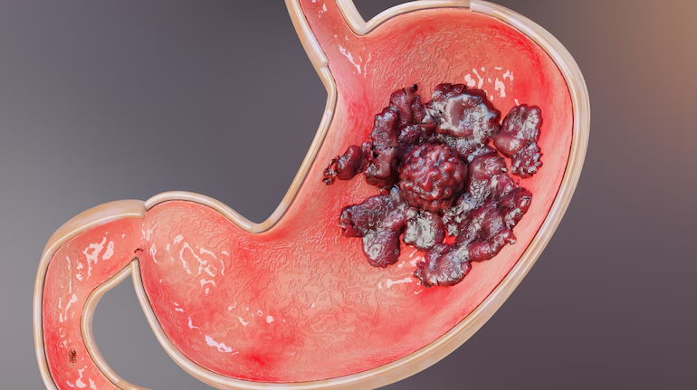 Peptic Ulcer – The Ayurveda Cure